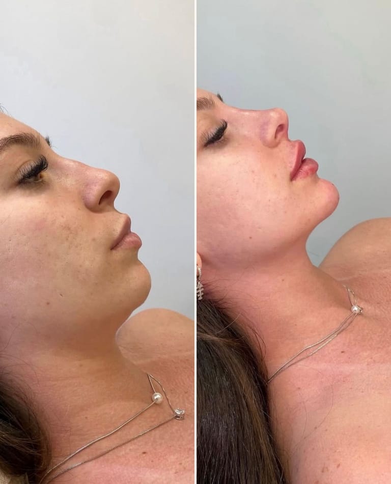 Caso 01 — antes e depois, imagem publicada mediante autorização do paciente