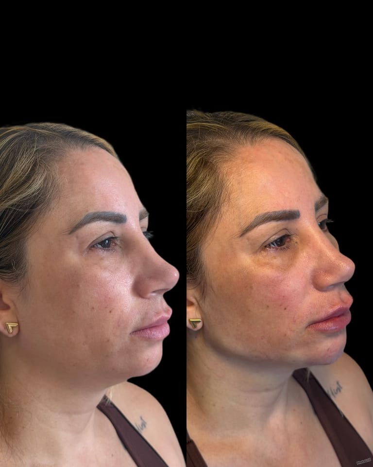 Caso 04 — antes e depois, imagem publicada mediante autorização do paciente
