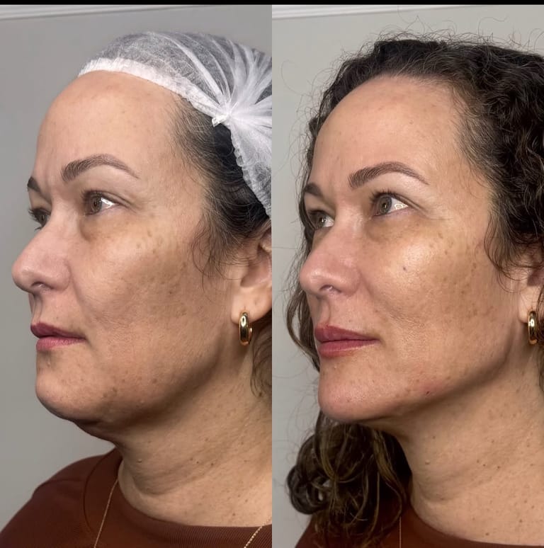 Caso 05 — antes e depois, imagem publicada mediante autorização do paciente