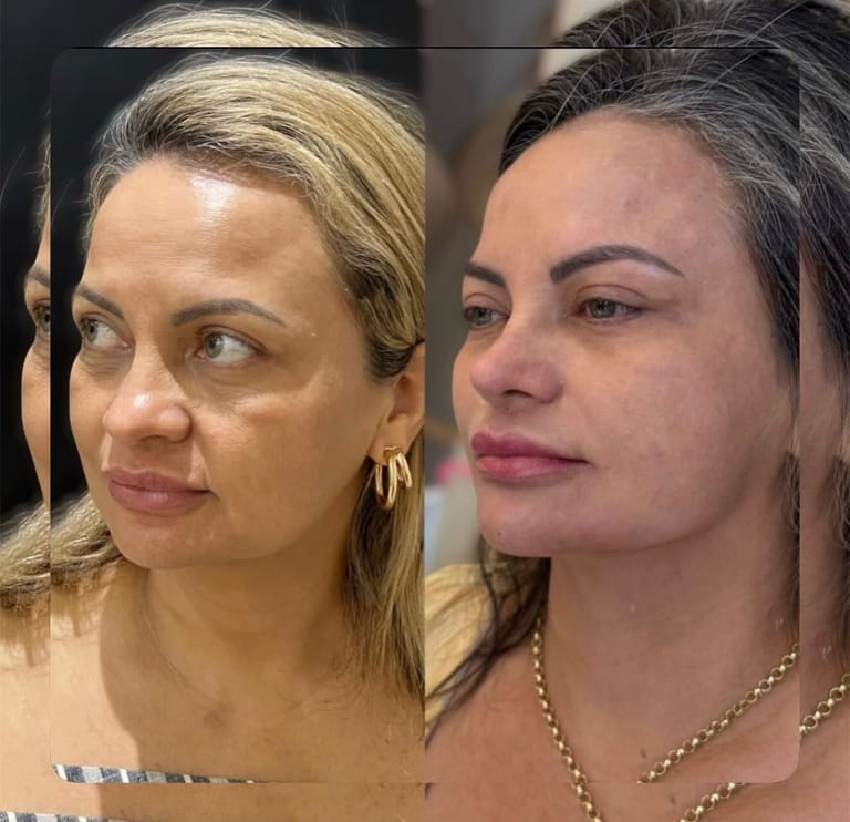 Caso 06 — antes e depois, imagem publicada mediante autorização do paciente